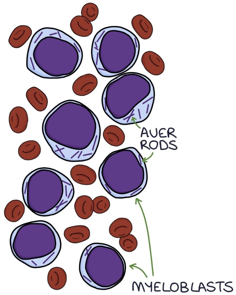 Leukaemia – Zero To Finals