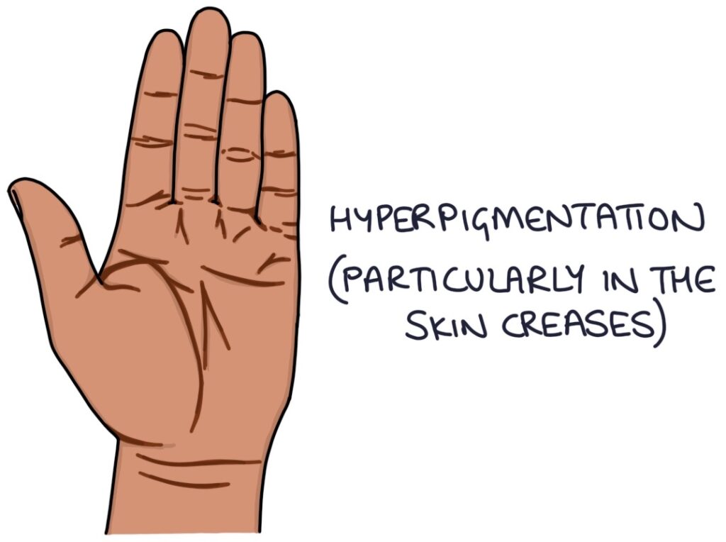 Adrenal Insufficiency Zero To Finals