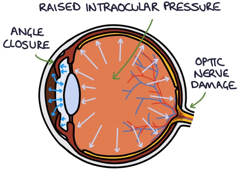 Acute AngleClosure Zero To Finals