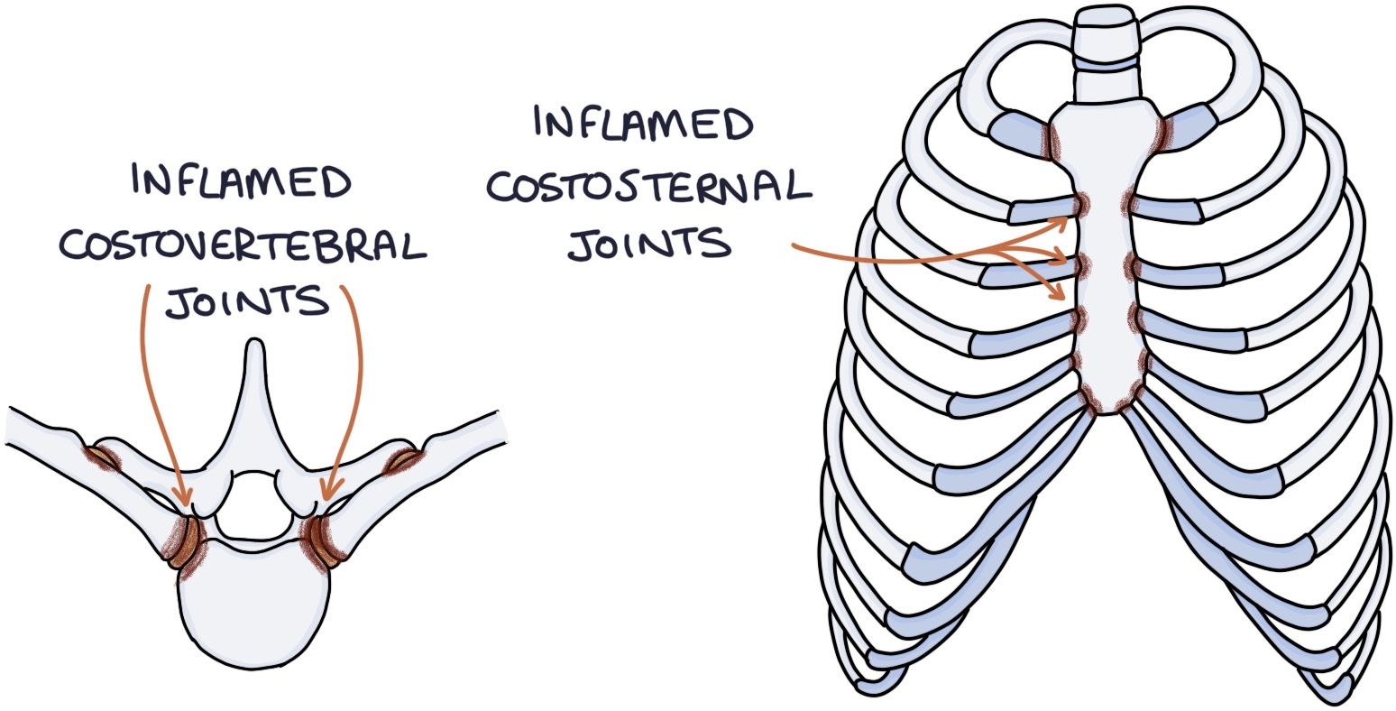 Spondylitis Ribs Ankylosing Spondylitis – Zero To Finals