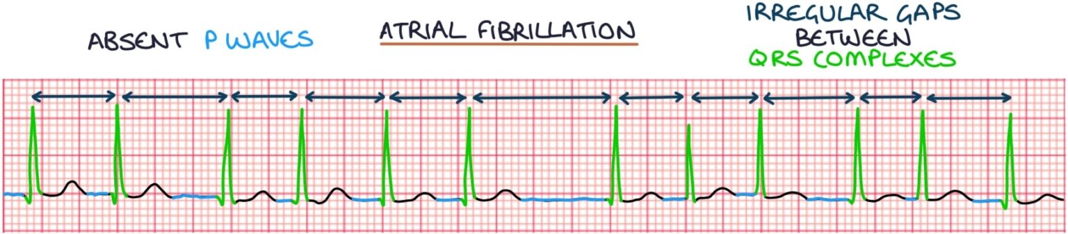 Atrial Fibrillation – Zero To Finals