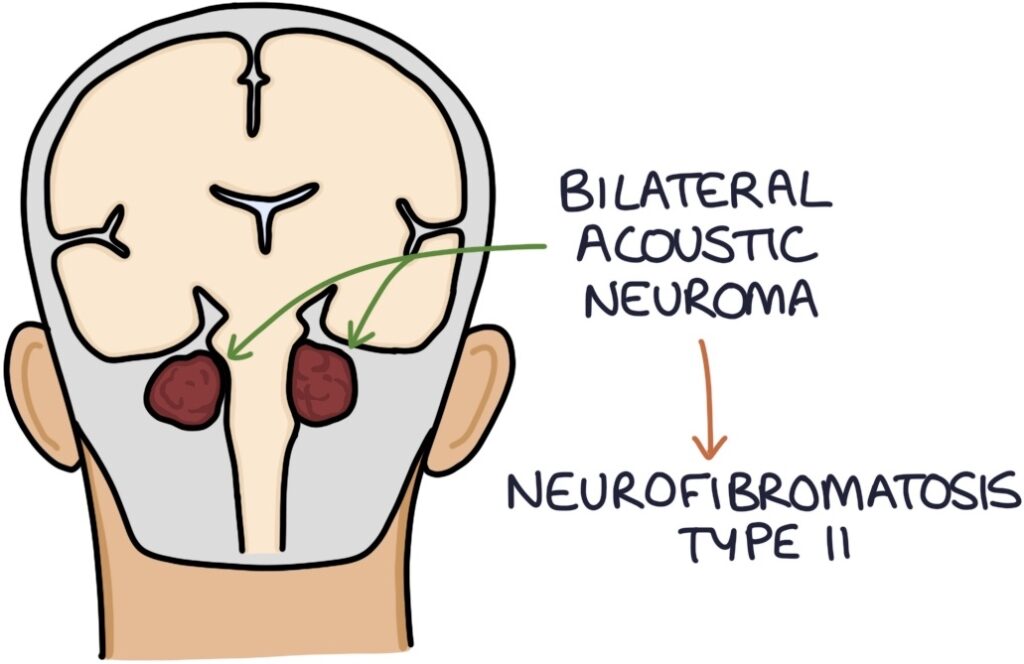 Acoustic Neuroma Zero To Finals