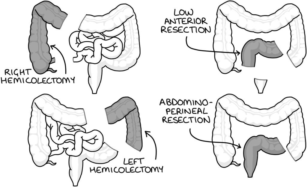 Bowel Cancer – Zero To Finals