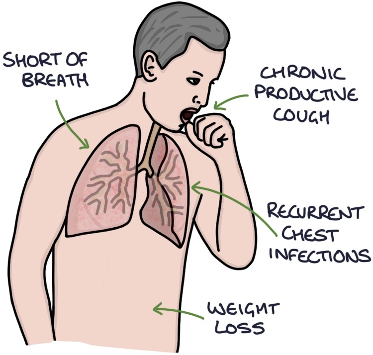 Bronchiectasis – Zero To Finals