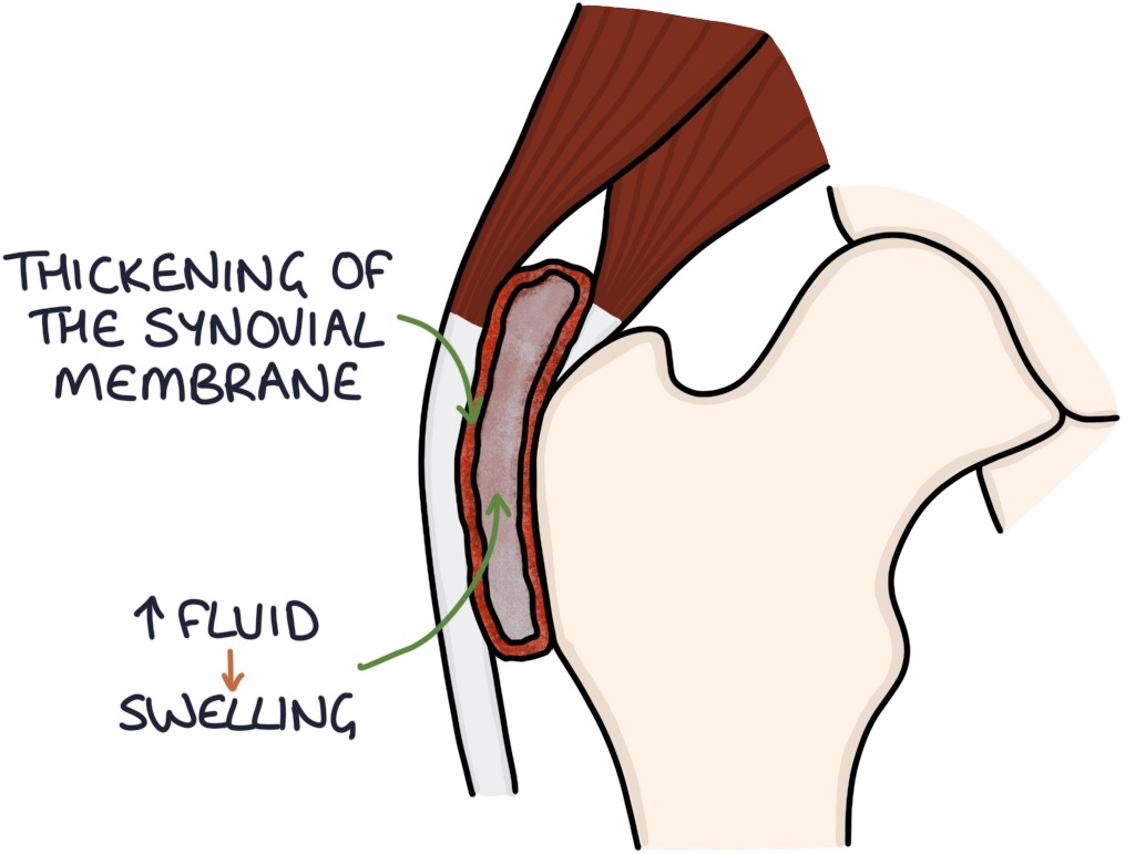 Trochanteric Bursitis Zero To Finals