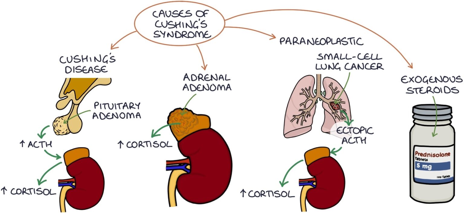 Cushing’s Syndrome Zero To Finals