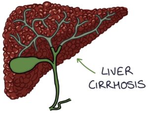 Liver Cirrhosis – Zero To Finals