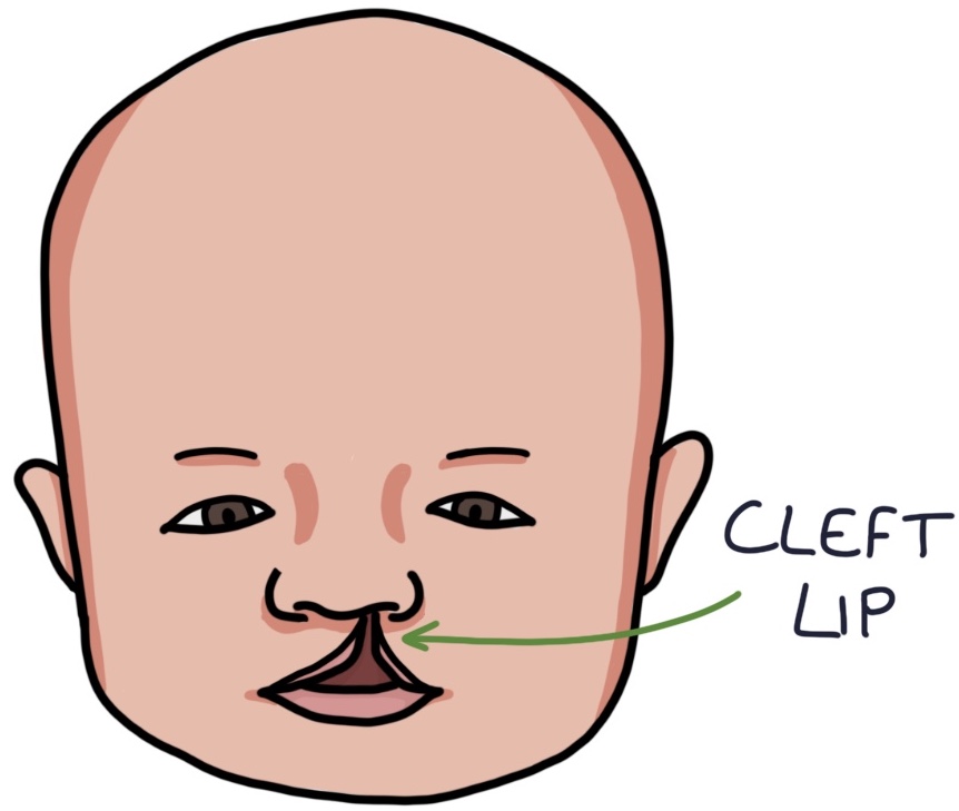 Cleft Lip Zero To Finals