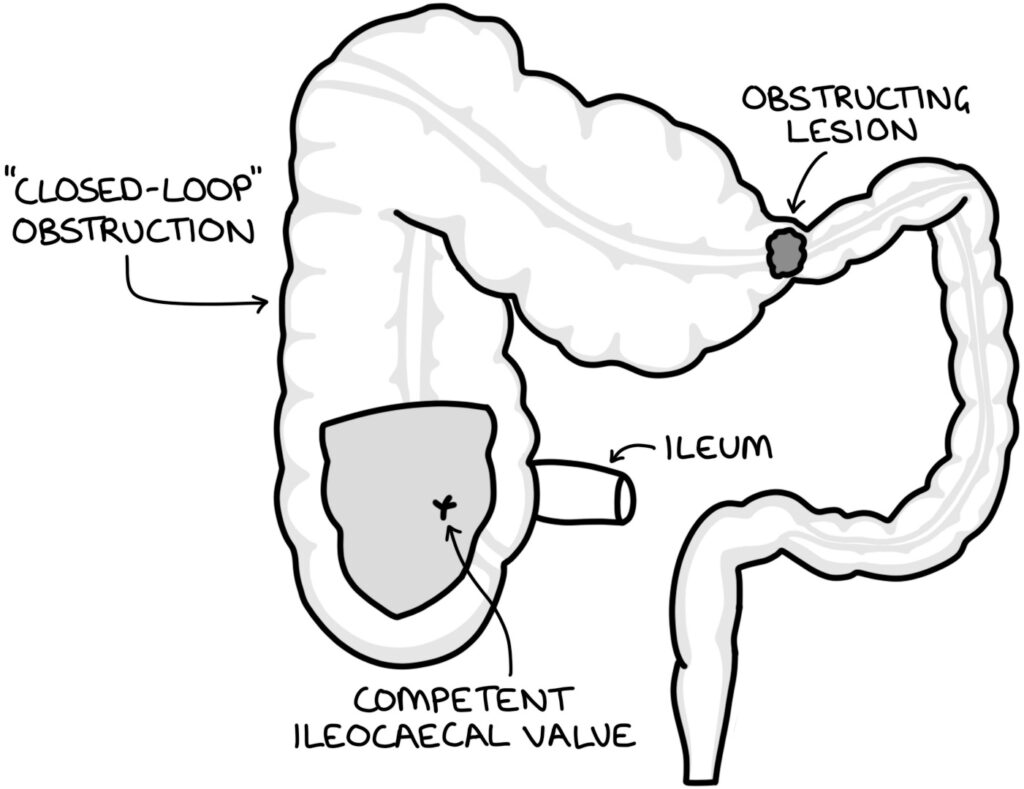 Bowel Obstruction – Zero To Finals