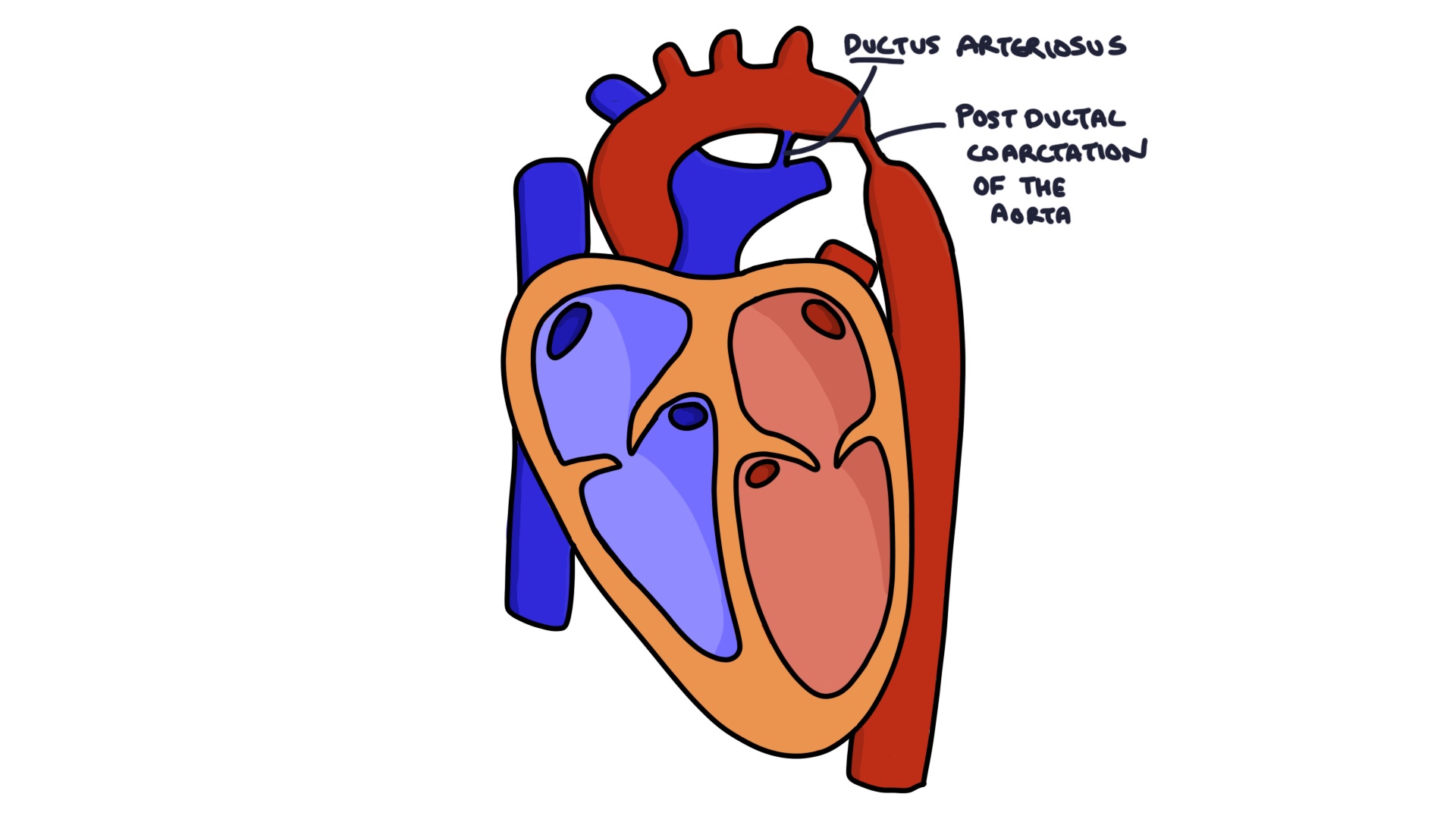 Coarctation of the Aorta – Zero To Finals