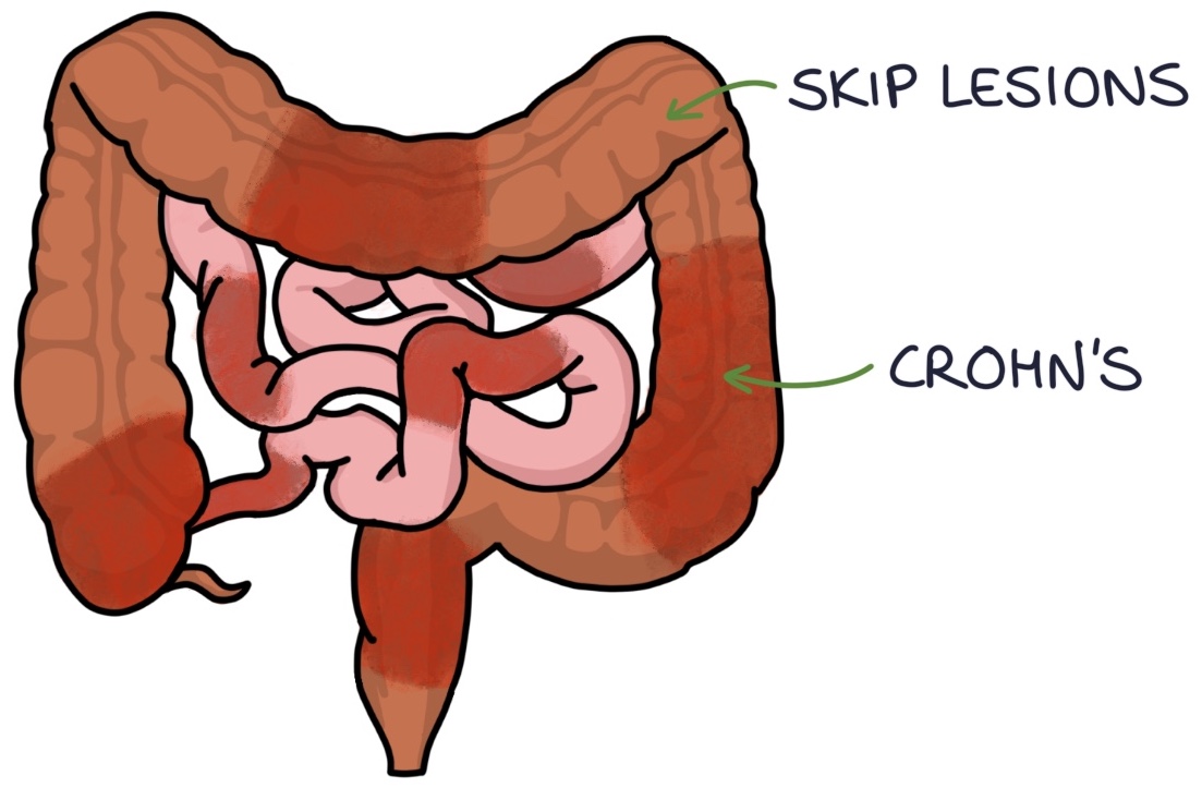 Inflammatory Bowel Disease – Zero To Finals