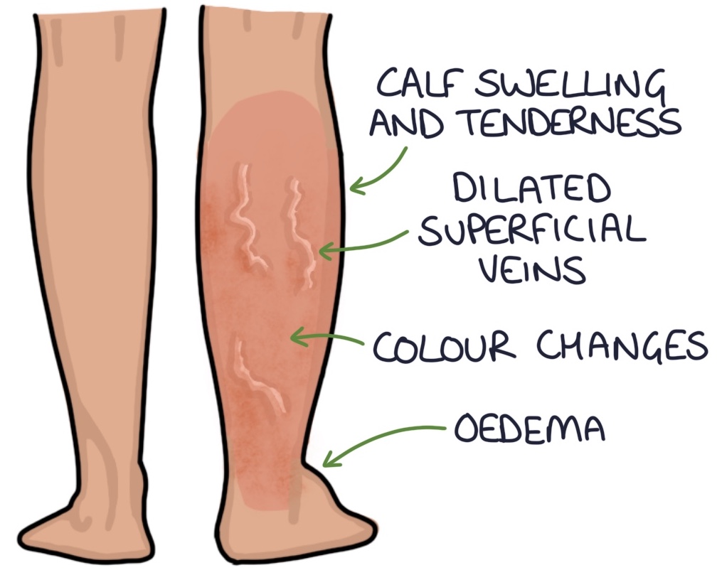 Deep Vein Thrombosis and Venous Thromboembolism Zero To Finals