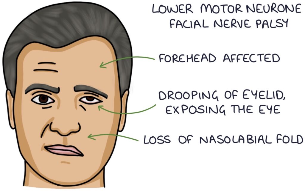 Left Facial Nerve Palsy
