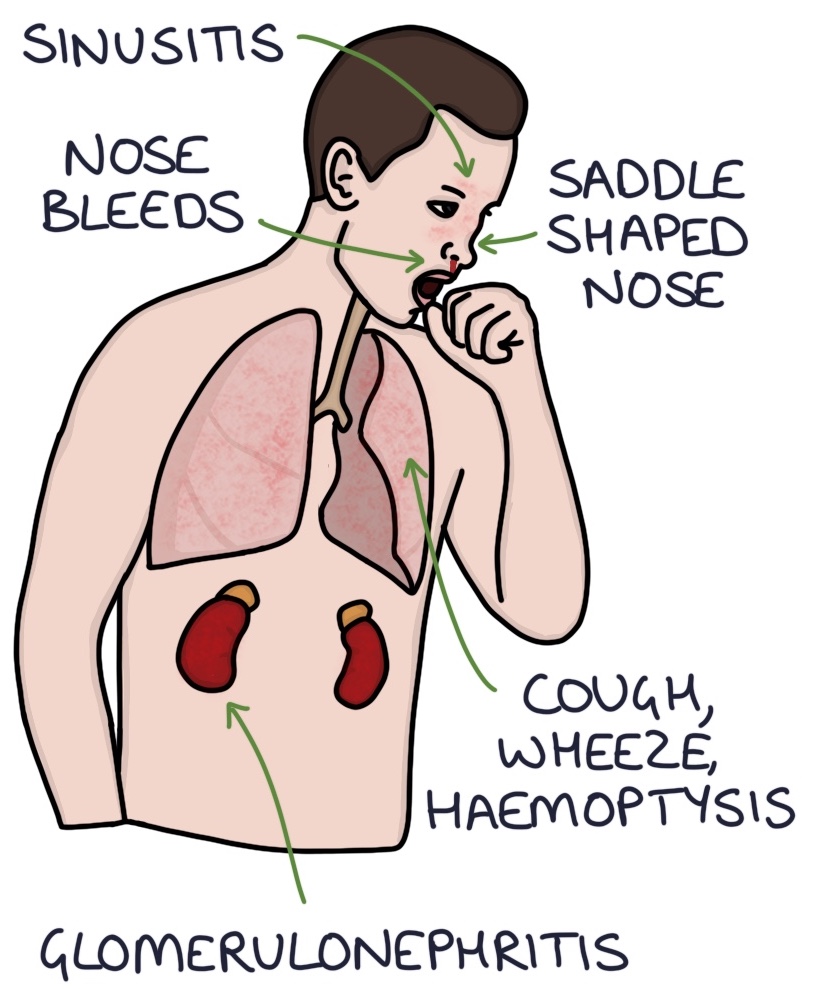 Vasculitis – Zero To Finals