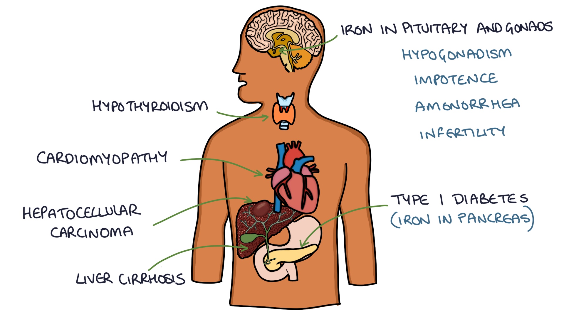 Haemochromatosis Zero To Finals 9702