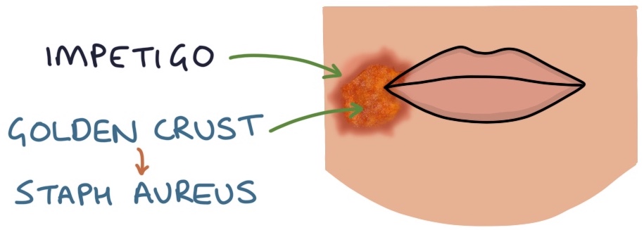 Intego Infection Skin and Soft Tissue Infections – Zero To Finals