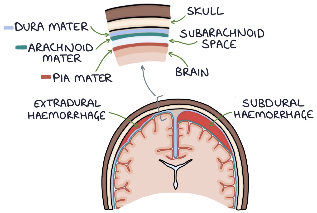 Intracranial Bleeds Zero To Finals