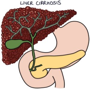 Primary Sclerosing Cholangitis – Zero To Finals