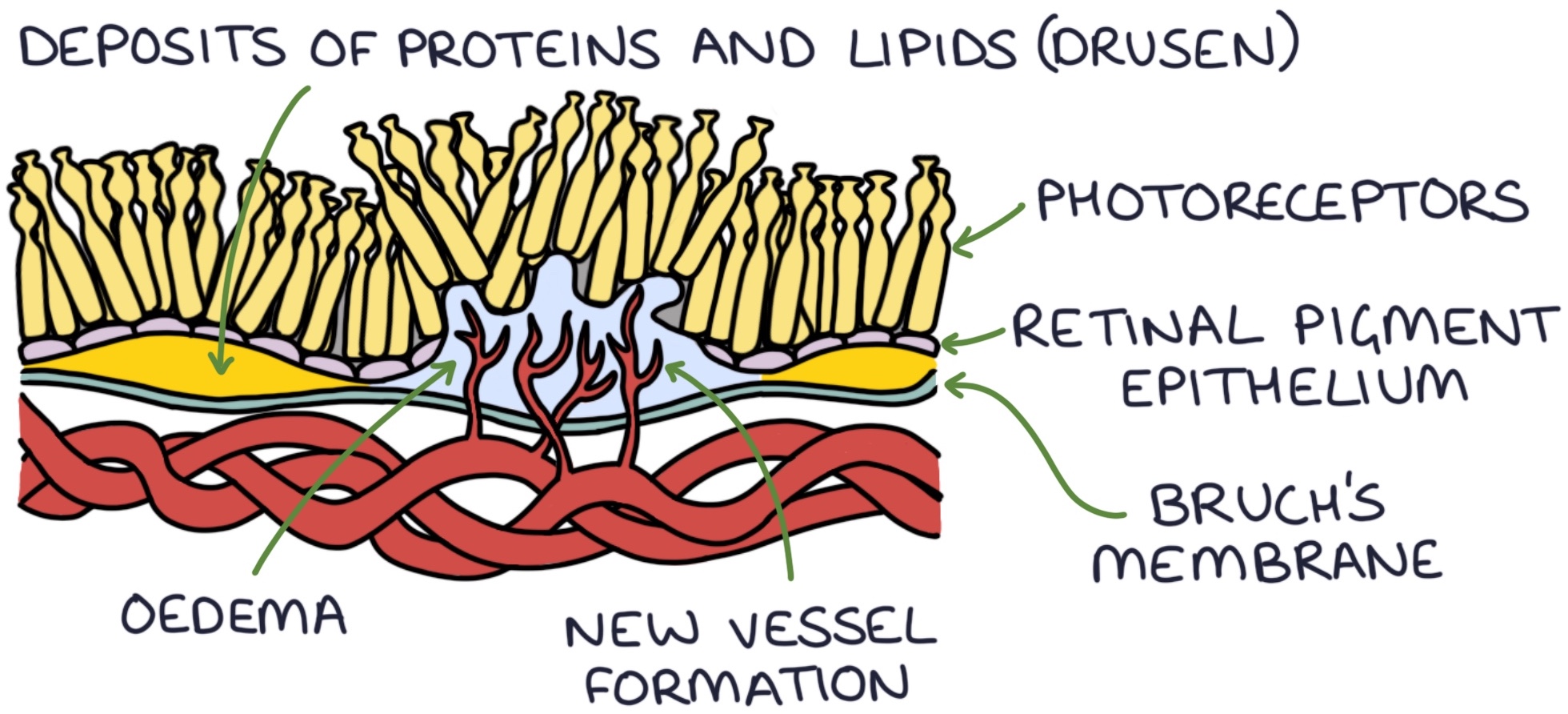 AgeRelated Macular Degeneration Zero To Finals