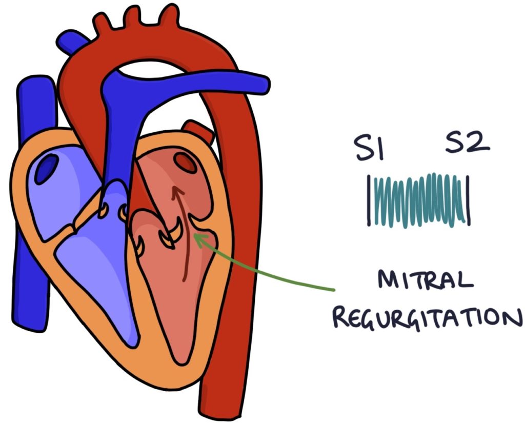 Prosthetic Heart Valves Zero To Finals