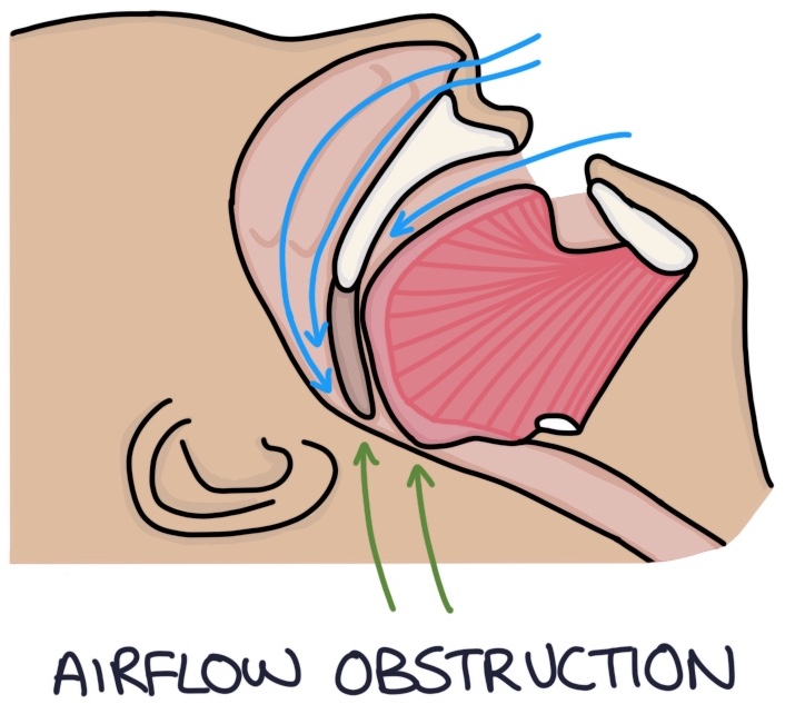 Obstructive Sleep Apnoea Zero To Finals