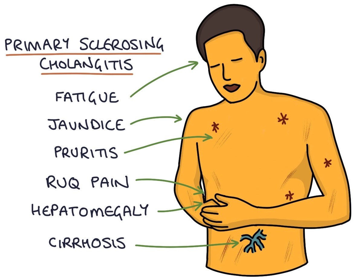 Primary Sclerosing Cholangitis – Zero To Finals