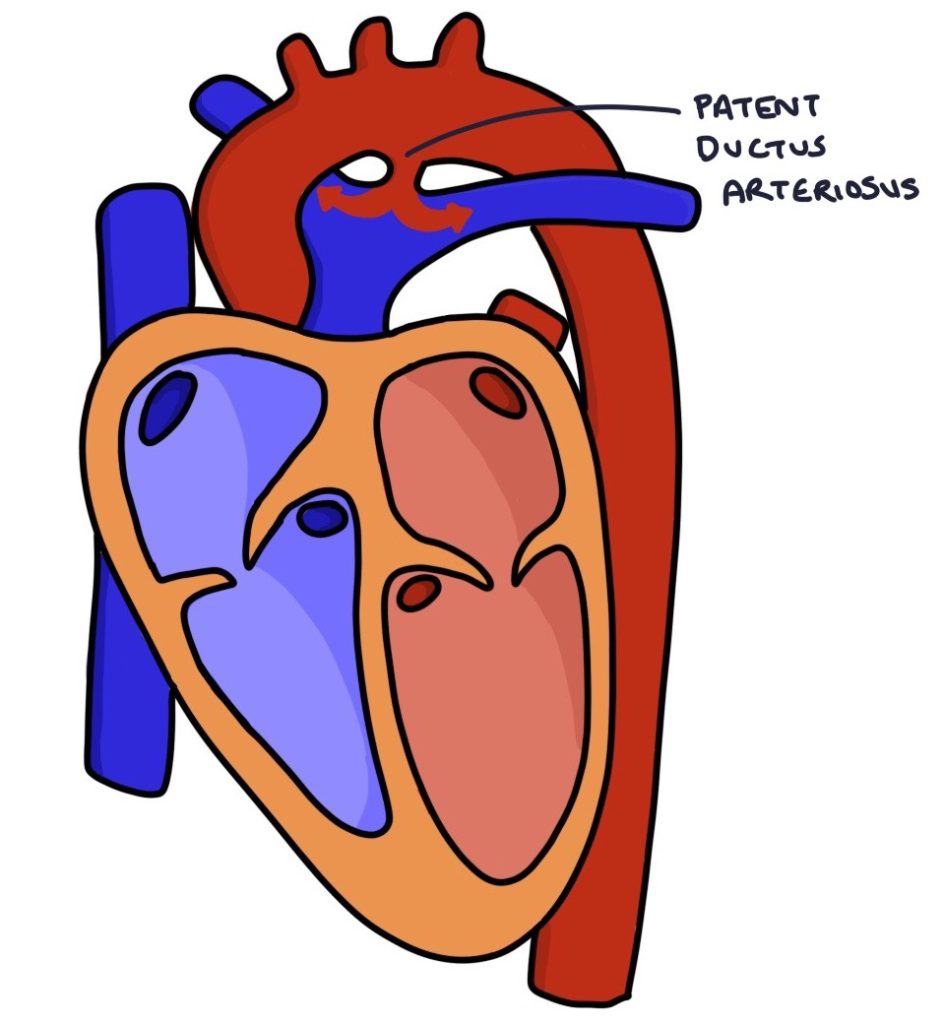 Pathophysiology Of Patent Ductus Arteriosus