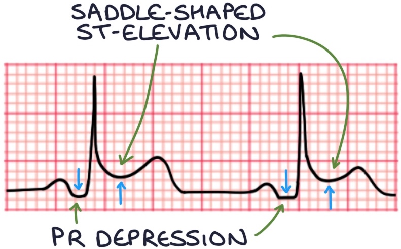 Pericarditis – Zero To Finals