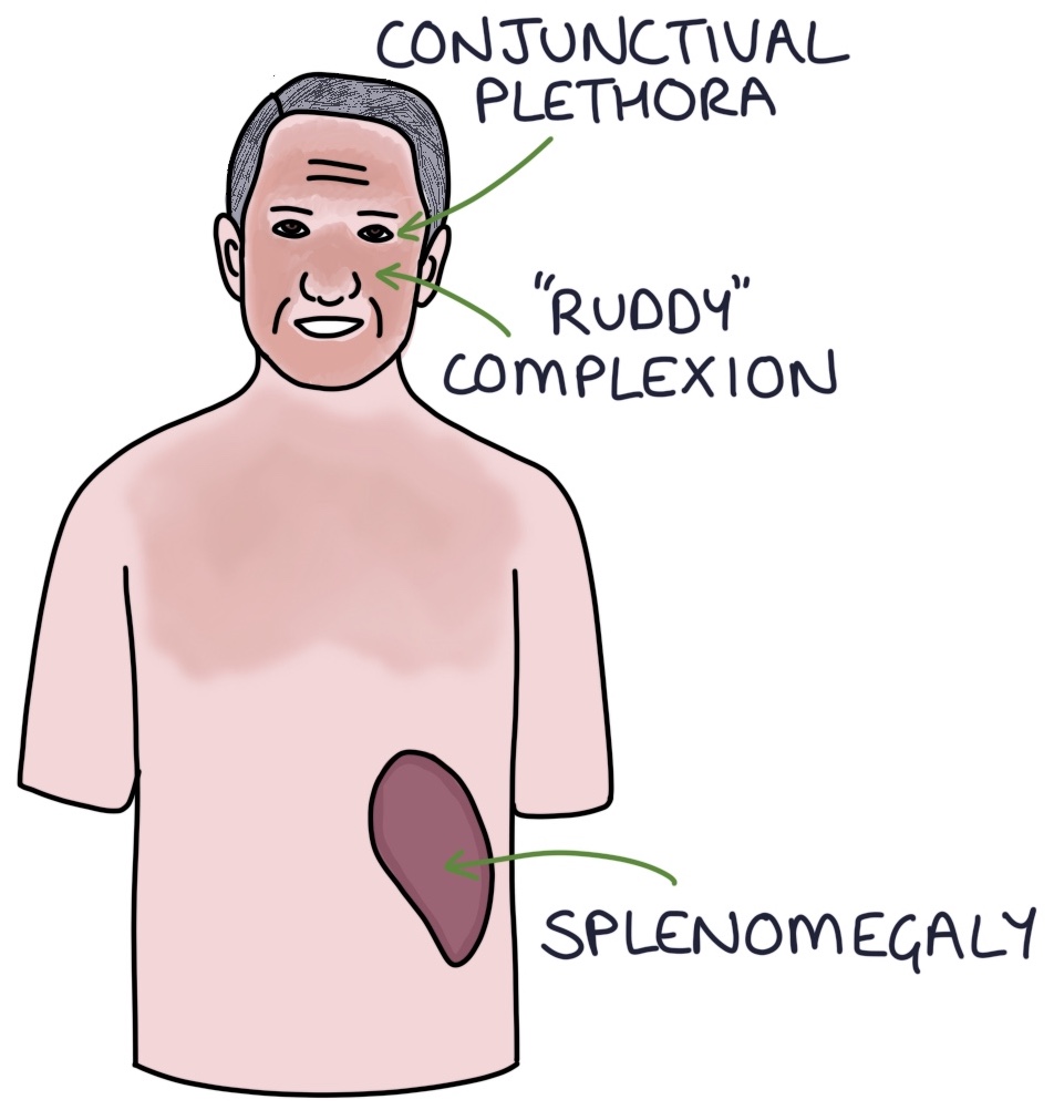 Myeloproliferative Disorders Zero To Finals