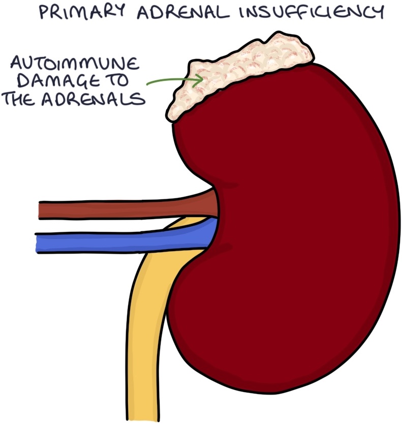 Adrenal Insufficiency – Zero To Finals