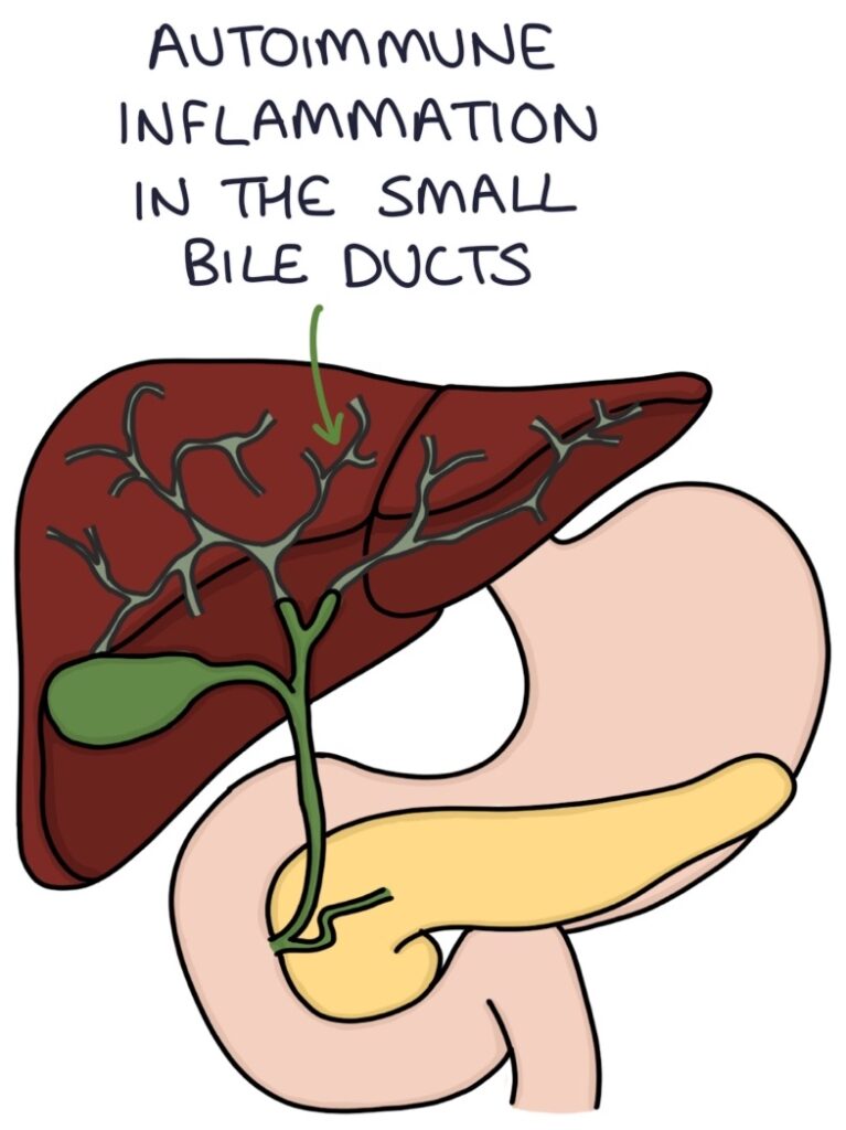 Primary Biliary Cholangitis – Zero To Finals