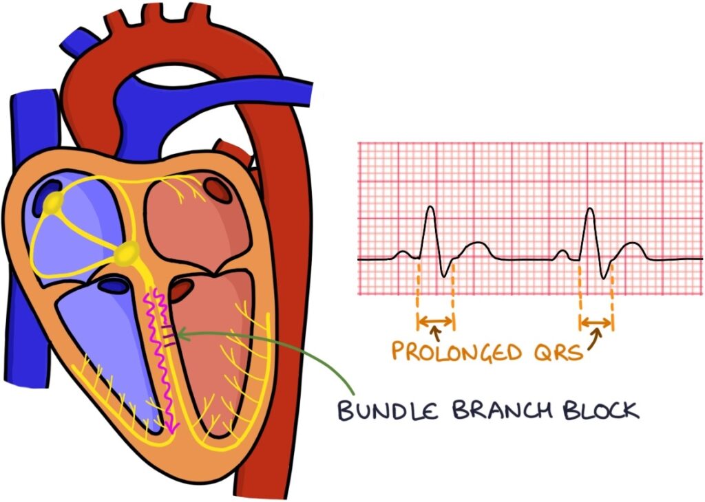 ECG Basics and Sinus Rhythm – Zero To Finals