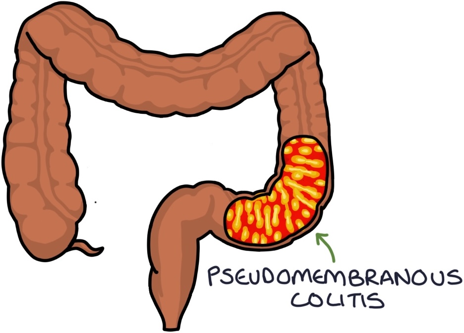 Clostridium Difficile Zero To Finals