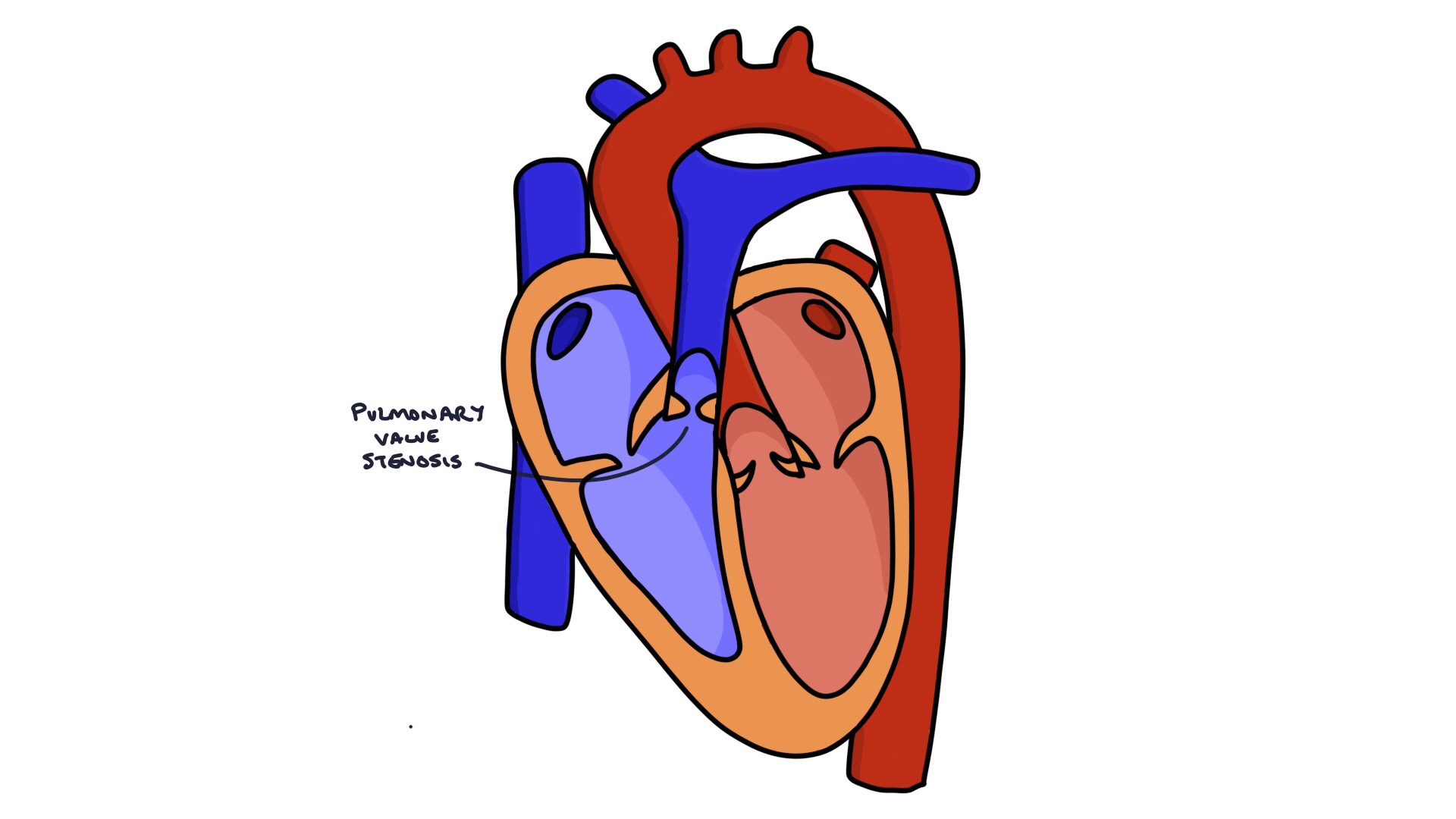 Pulmonary Valve Stenosis Zero To Finals