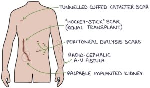 kidney transplant scar
