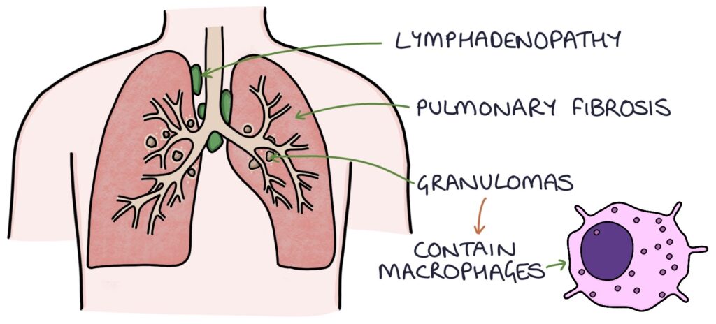 Sarcoidosis – Zero To Finals