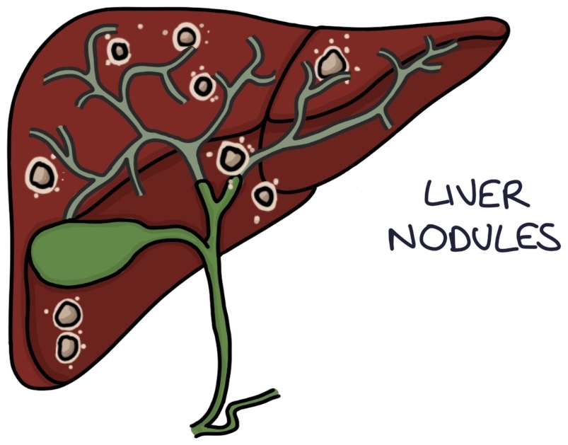 Sarcoidosis – Zero To Finals