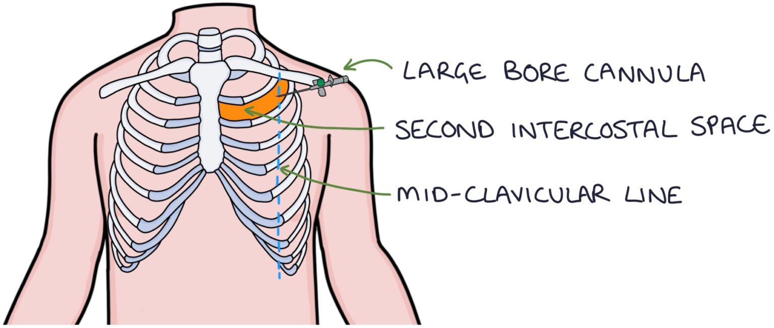 Pneumothorax – Zero To Finals