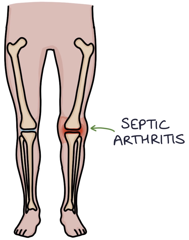 Septic Arthritis Zero To Finals