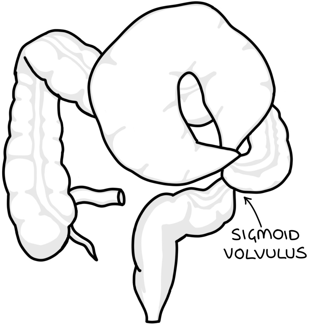 Volvulus – Zero To Finals