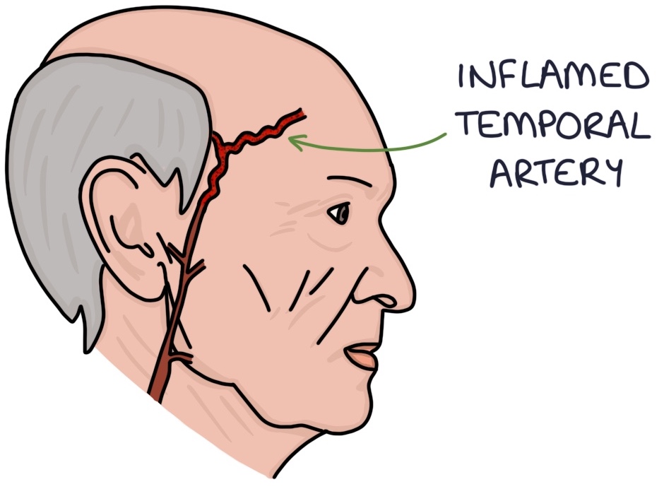 giant-cell-arteritis-zero-to-finals