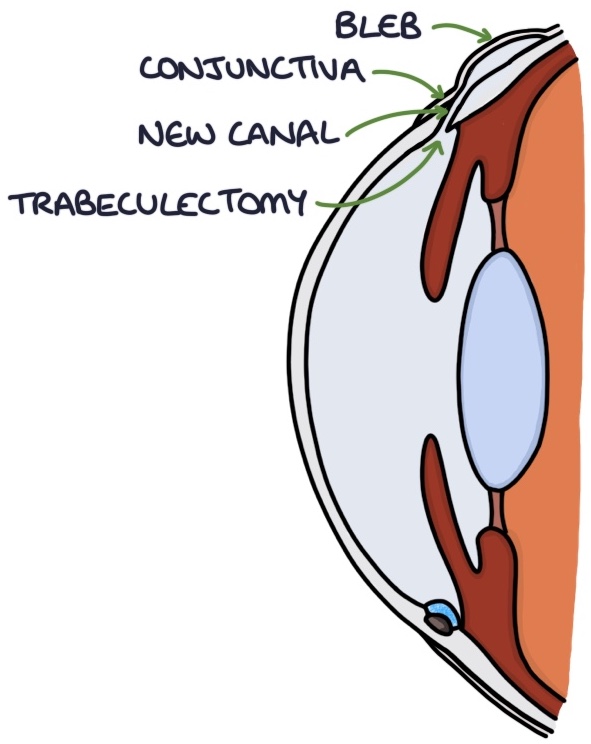 Open Angle Zero To Finals