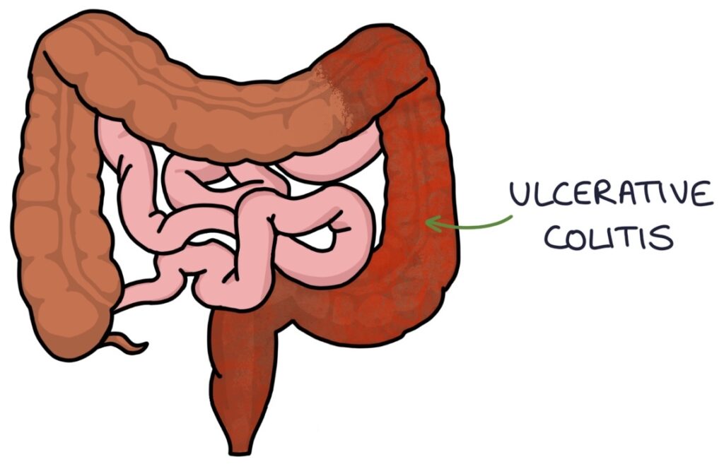 Inflammatory Bowel Disease – Zero To Finals