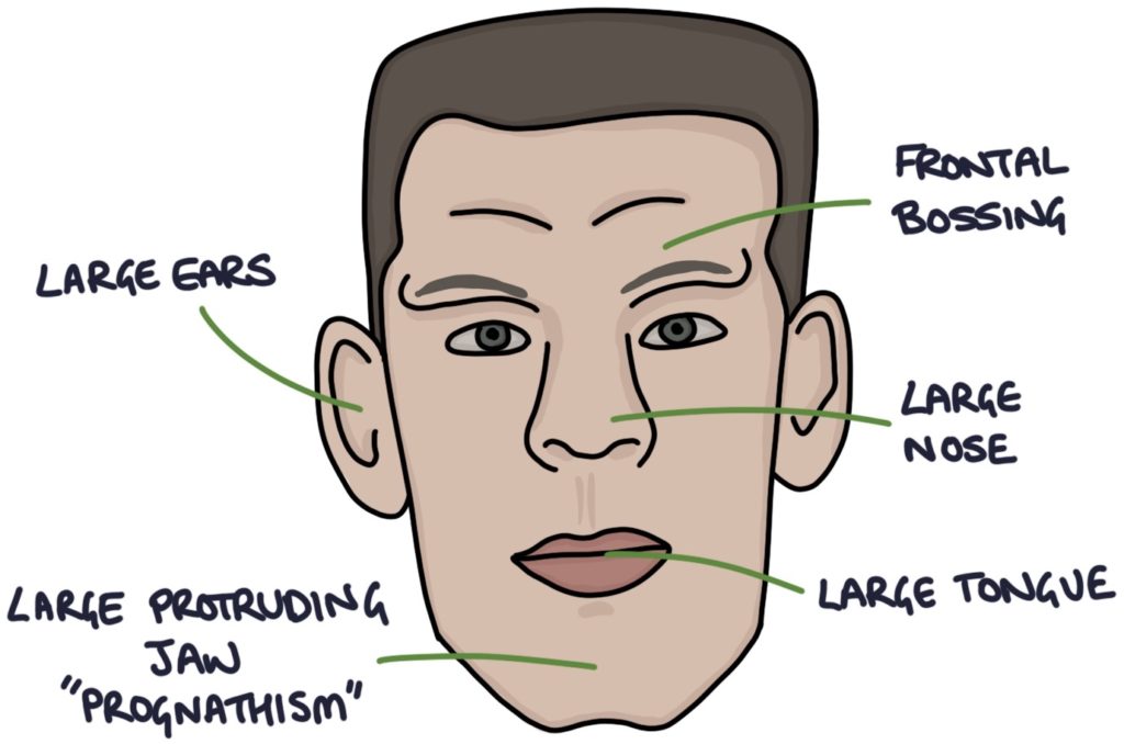 Acromegaly – Zero To Finals