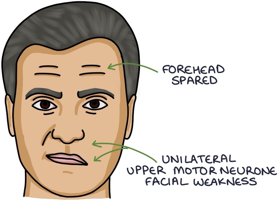 Facial Nerve Palsy – Zero To Finals