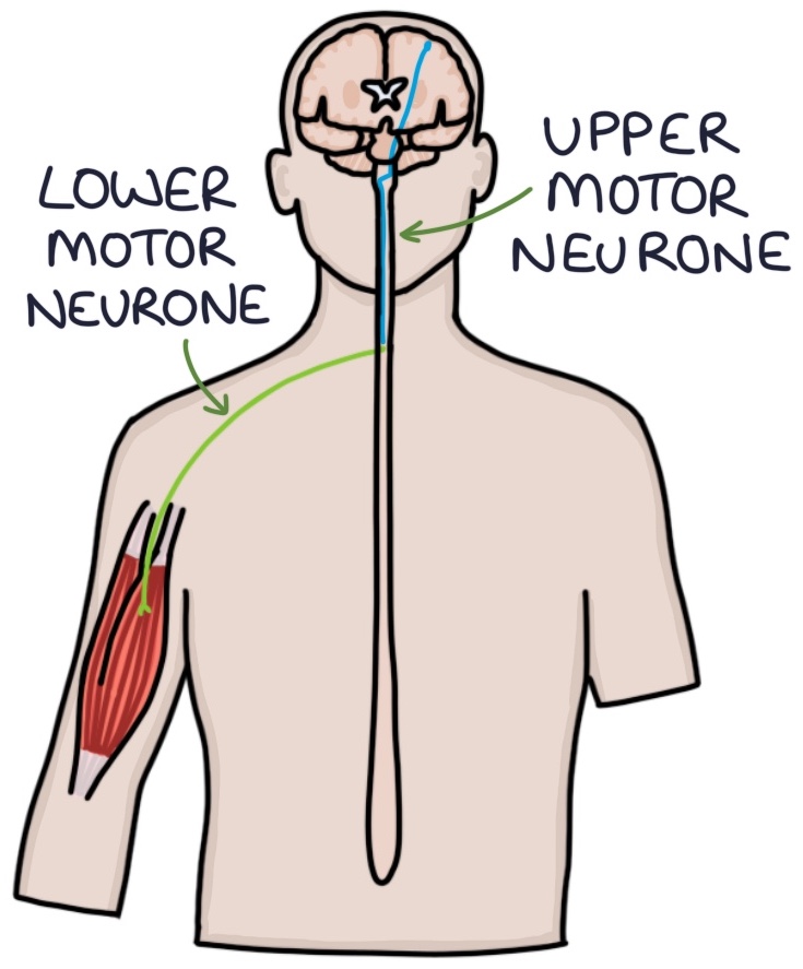 Upper Vs Lower Motor Neuron Signs