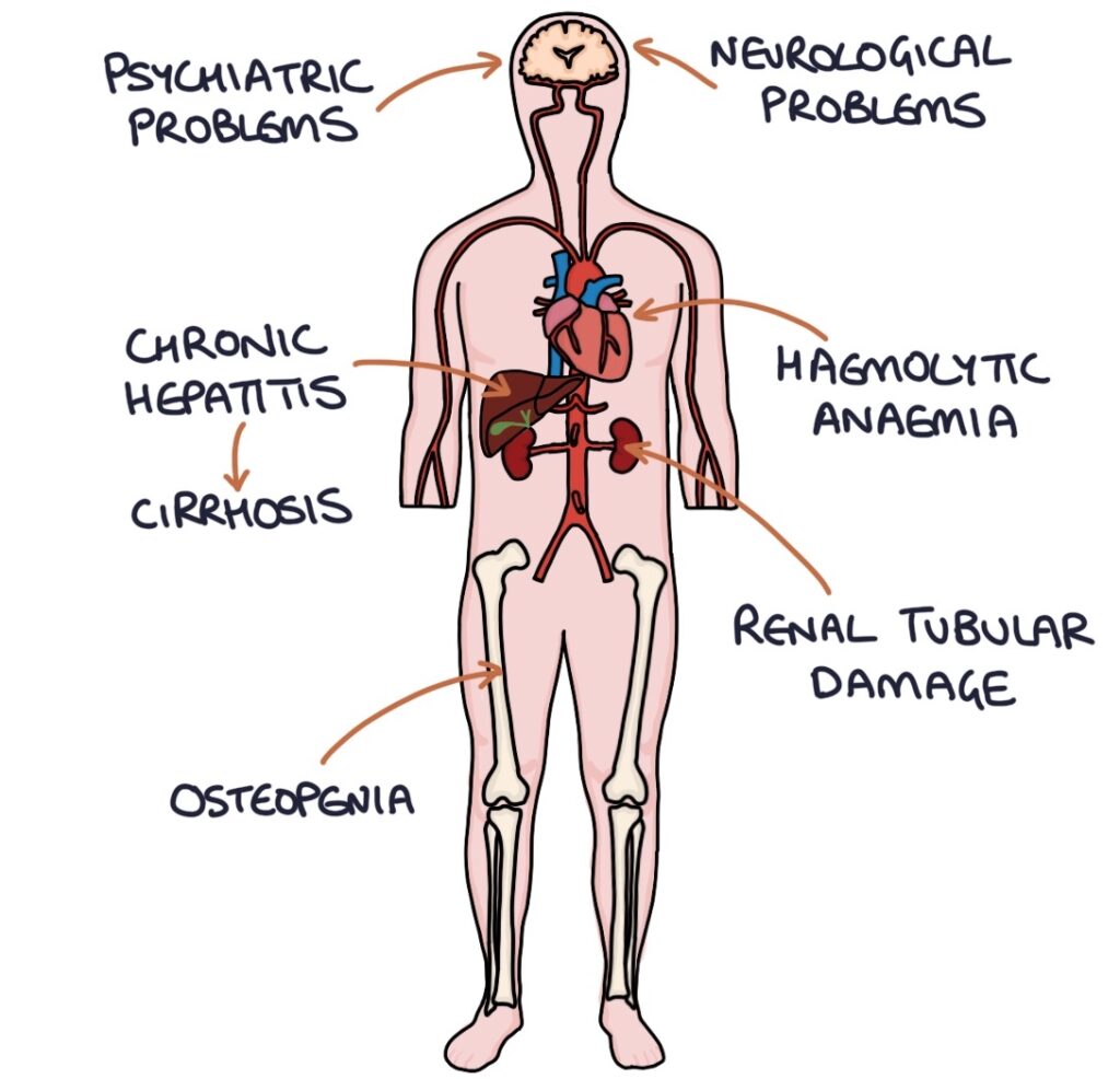 Wilson’s Disease Zero To Finals