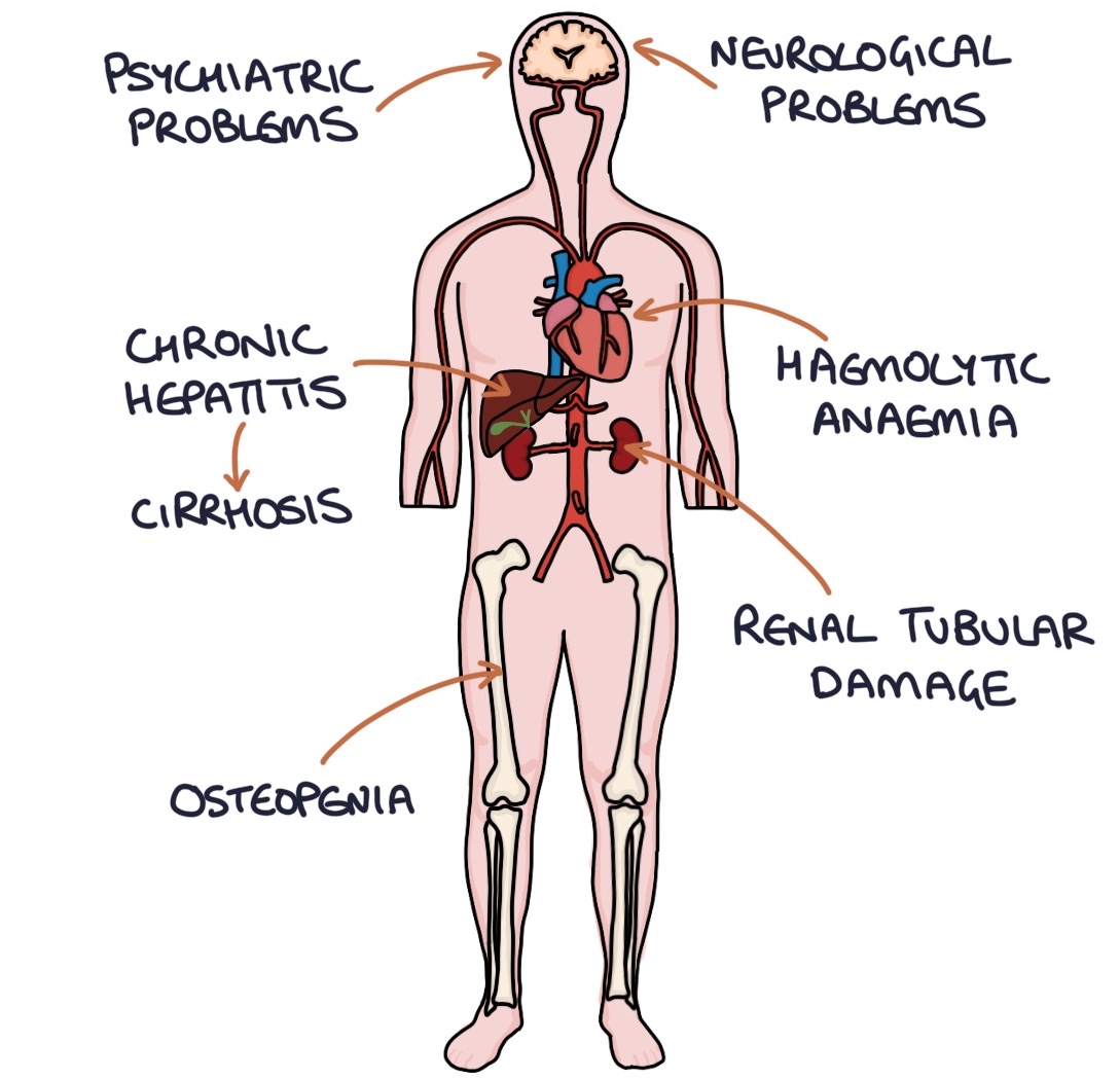 Wilson’s Disease Zero To Finals